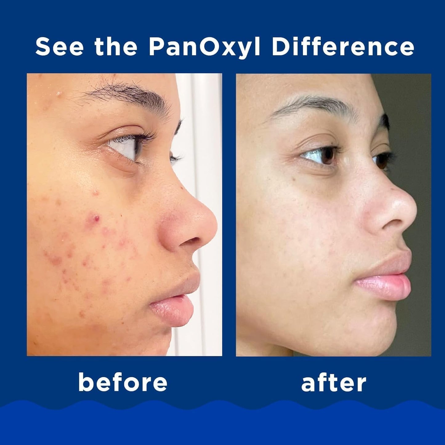 PanOxyl Maximum Strength 10% Benzoyl Peroxide Foaming Acne Wash