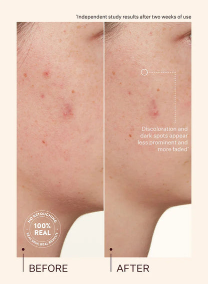 Peach & Lily Transparen-C Vitamin C Dark Spot & Acne Treatment