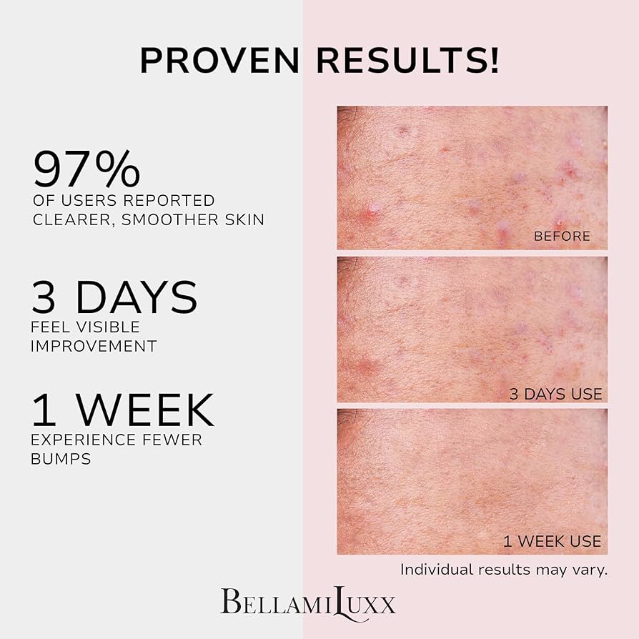 BellamiLuxx Butt & Body Acne Clearing Cream with Salicylic Acid